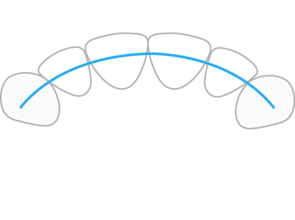 ProTain™ contention digitale, mâchoire supérieure