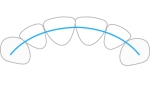 ProTain™ contention digitale, mâchoire supérieure